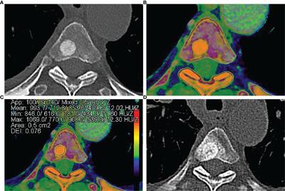 Dual-Energy Computed Tomography For Differentiation Between Osteoblastic Metastases and Bone Islands